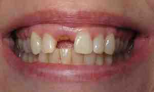 Is it possible to implant front teeth?