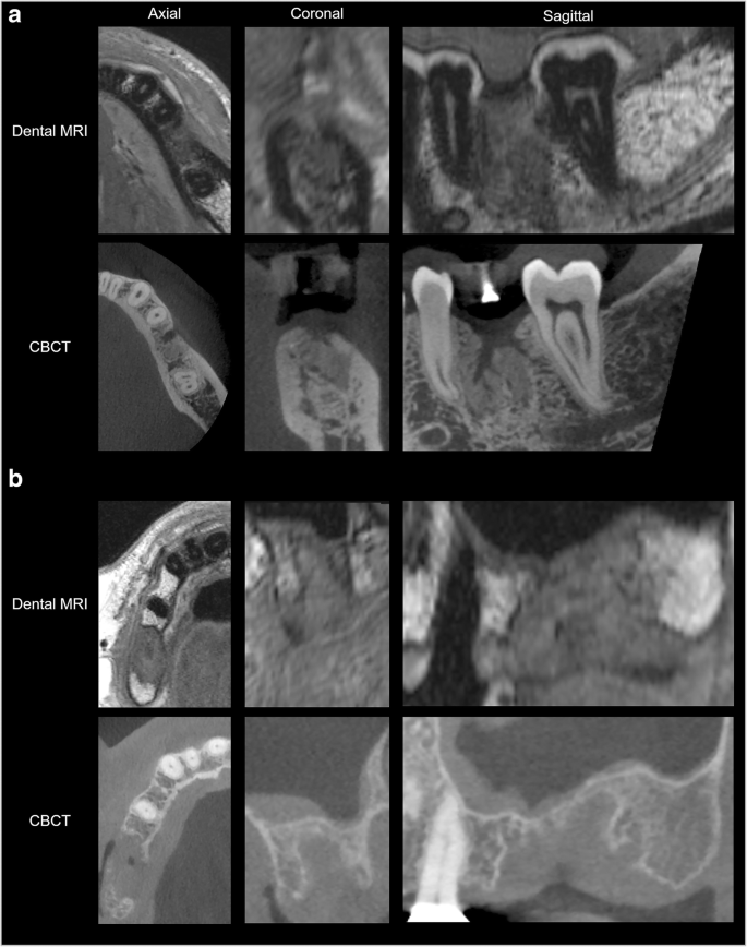 Can you have a mri with dental implants Dental News Network