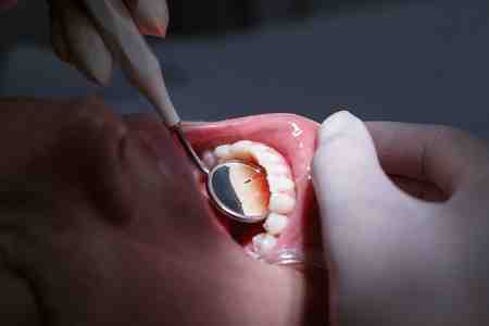 Is pinhole surgery permanent?