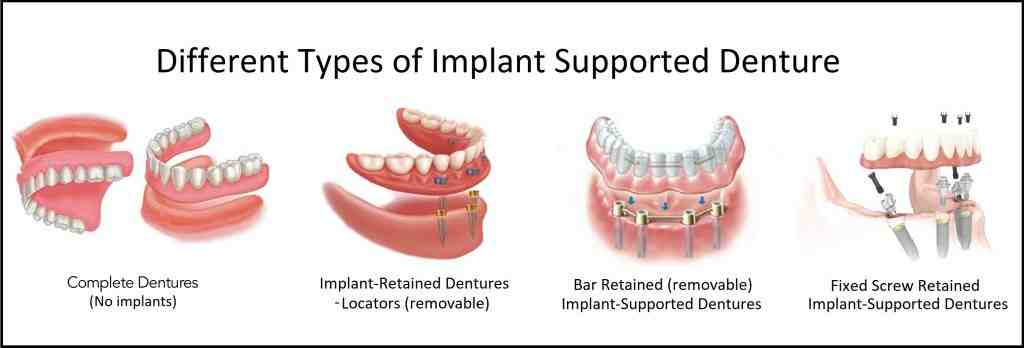 What are the 2 main types of dental implants today?