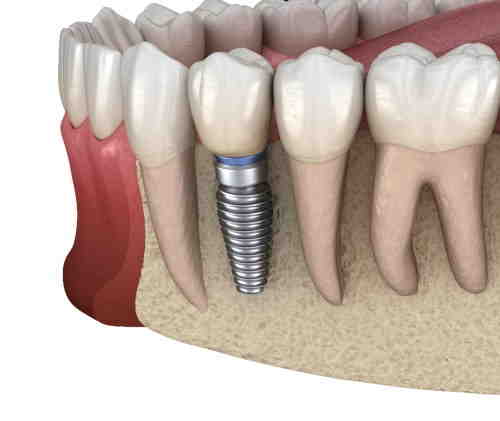 What are the signs of dental implant failure?