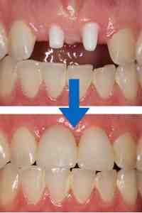 What are the symptoms of titanium toxicity?