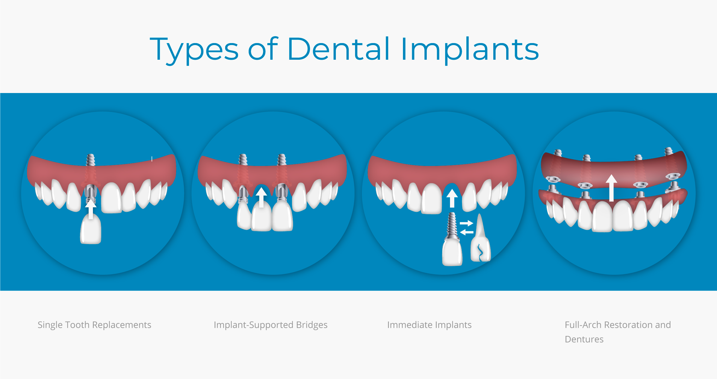 What are the types of implants?