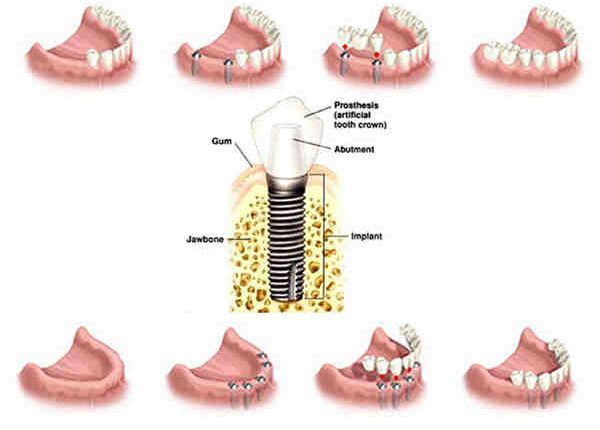 What are types of dental implants