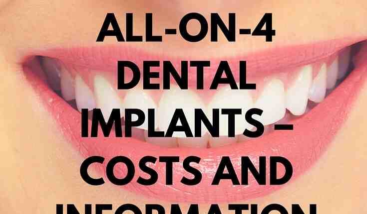 What does 4 for all dental implants cost