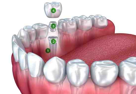 does-oregon-health-plan-cover-dental-implants-dental-news-network