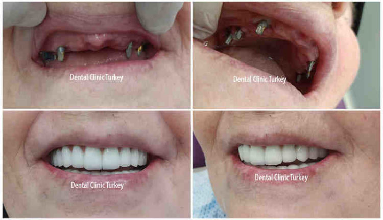 What does a full mouth of dental implants cost