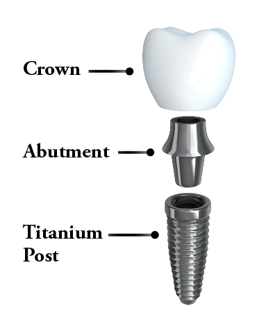What does an implant consist of?