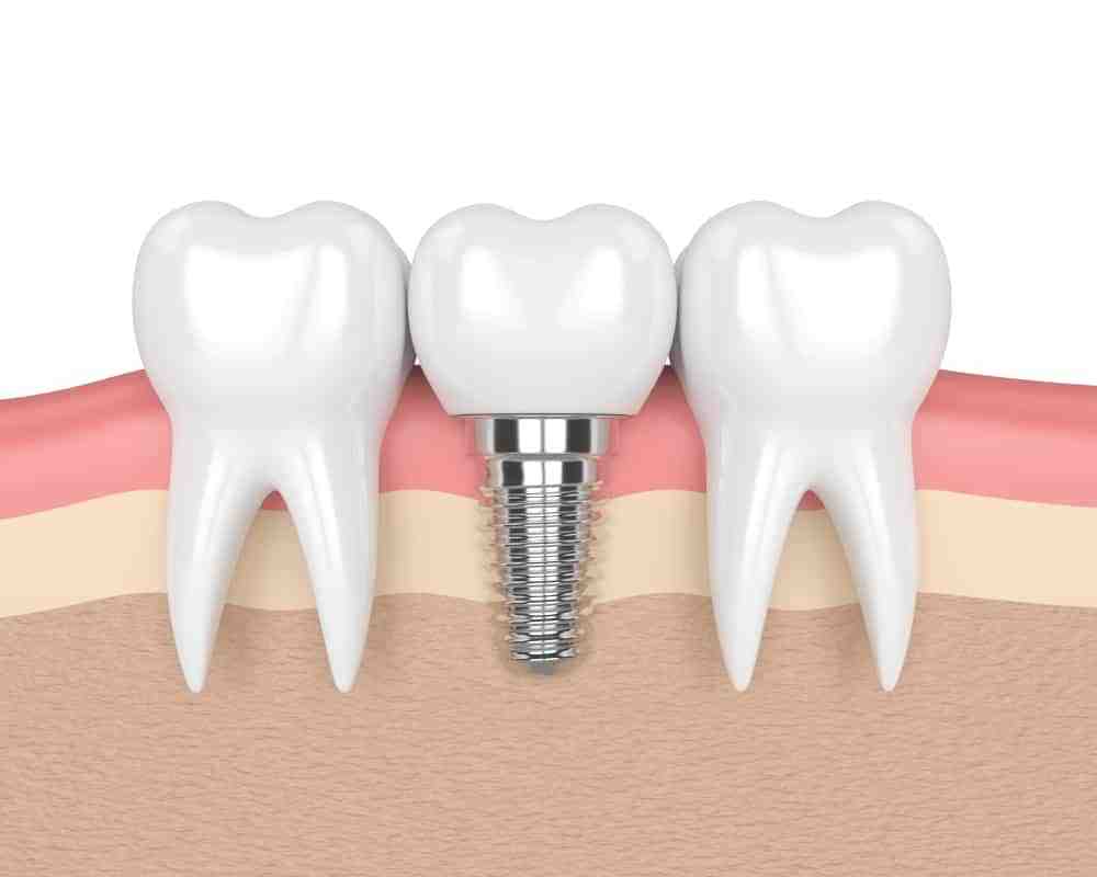 How much bone is needed for a dental implant Dental News Network