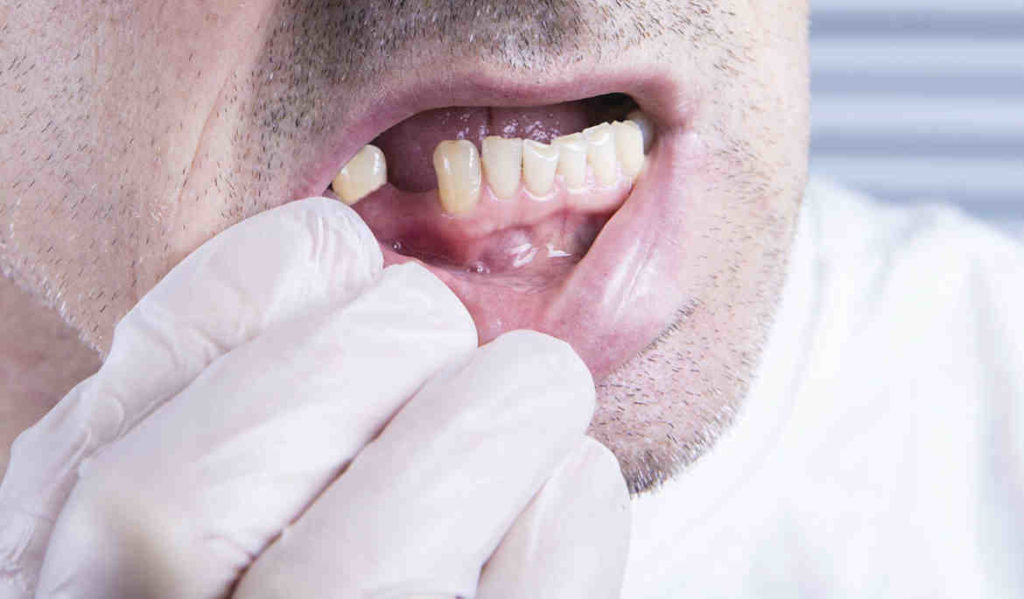 Can a dental implant fall out Dental News Network