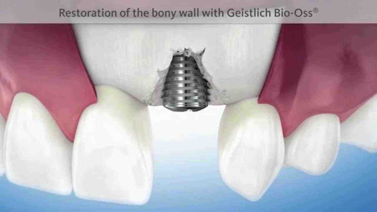 What happens when implant fails?