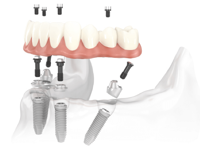 What hurts more tooth extraction or implant?