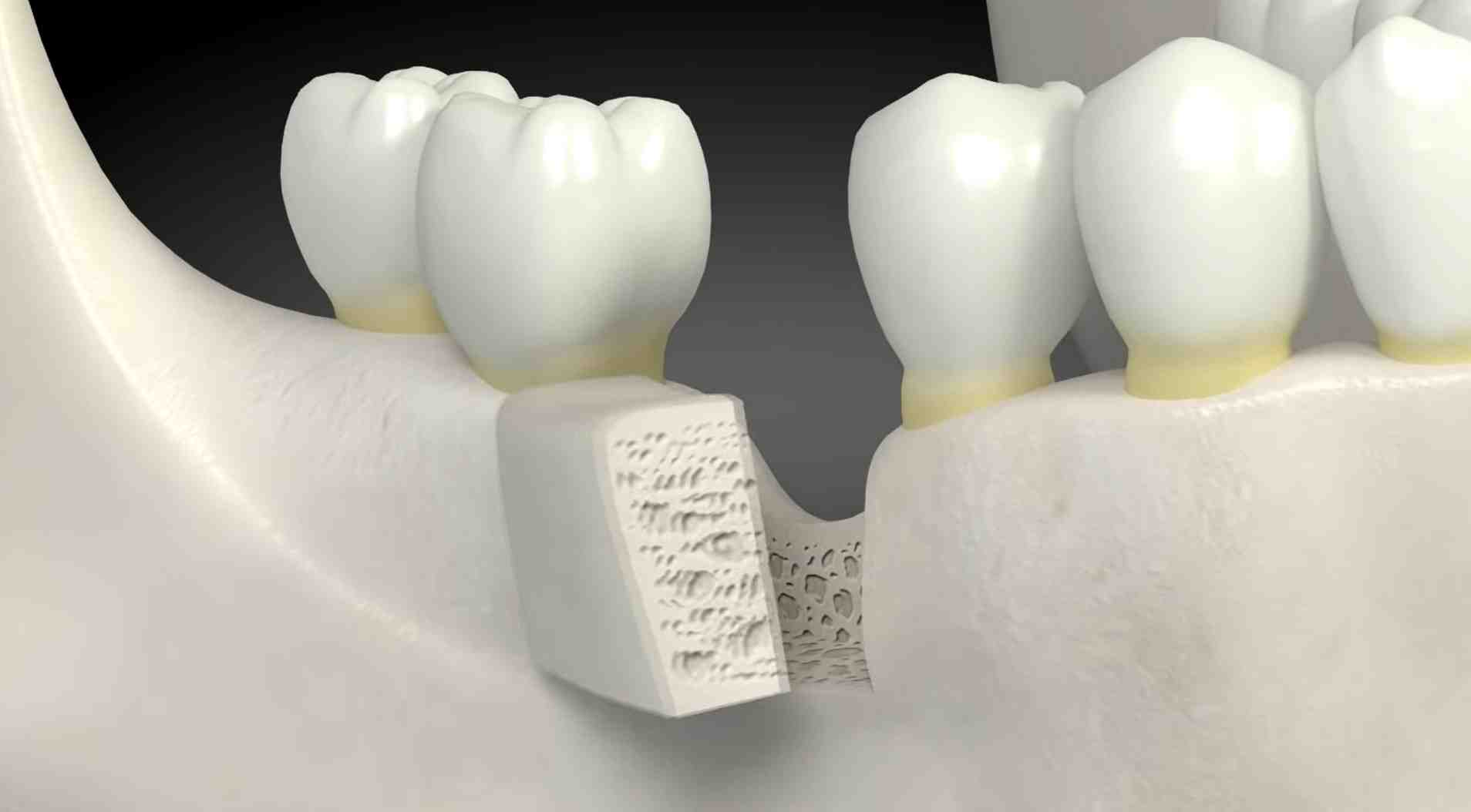 What is dental implant with bone graft Dental News Network