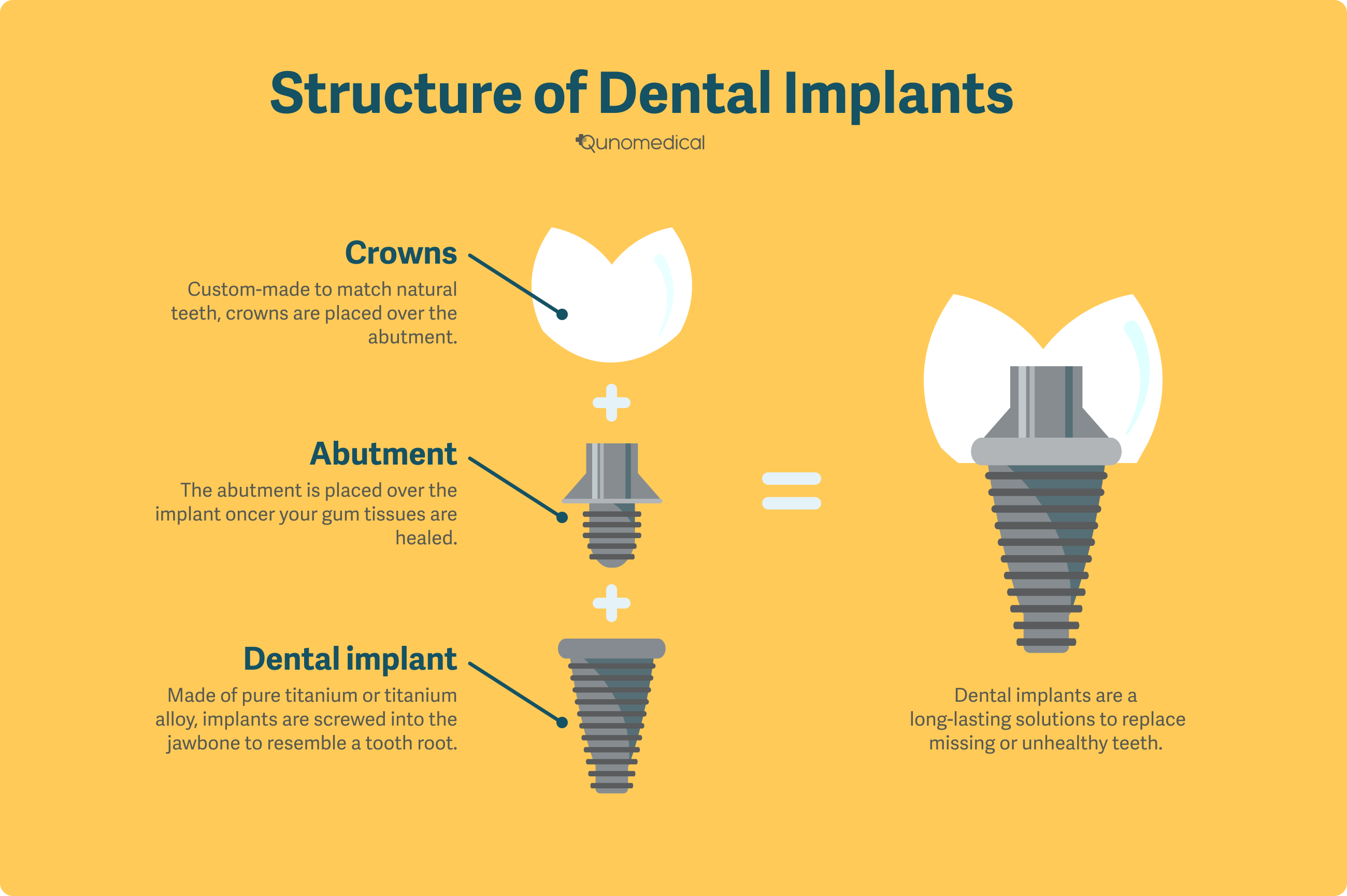 What are the parts of dental implant - Dental News Network