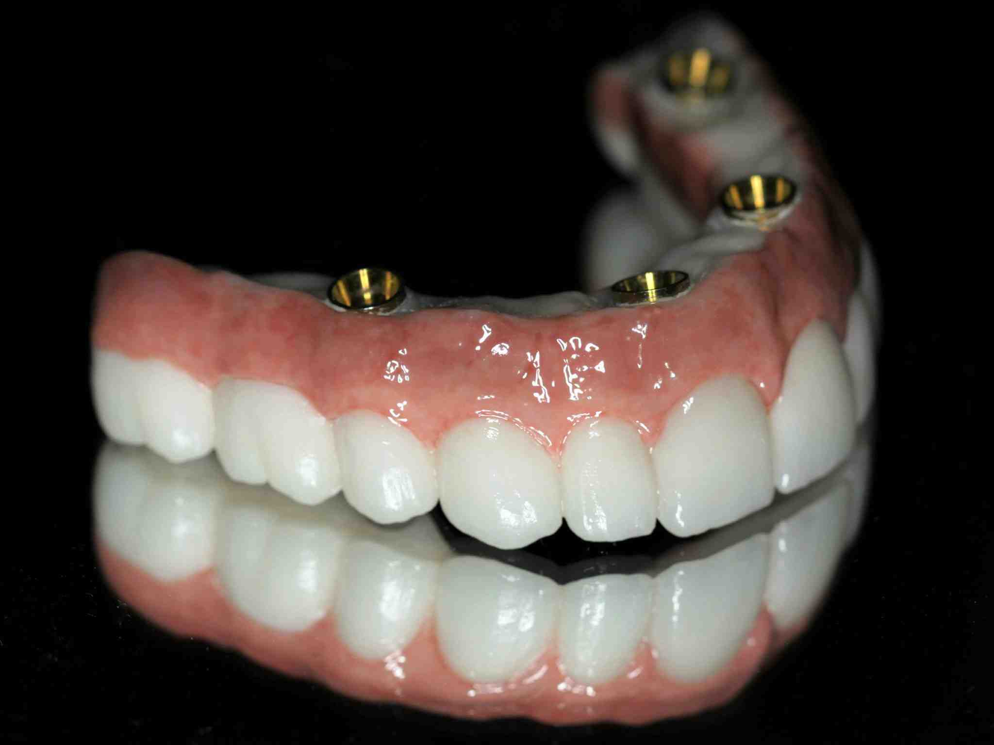 What is a reasonable price for dental implants?