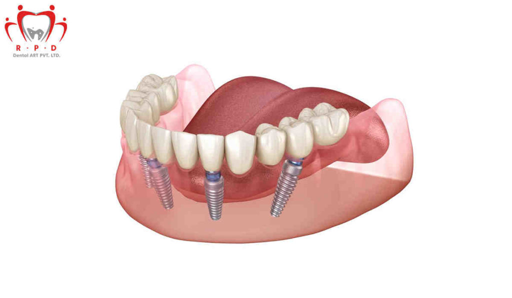 What is the profit margine for dental implants Dental News Network