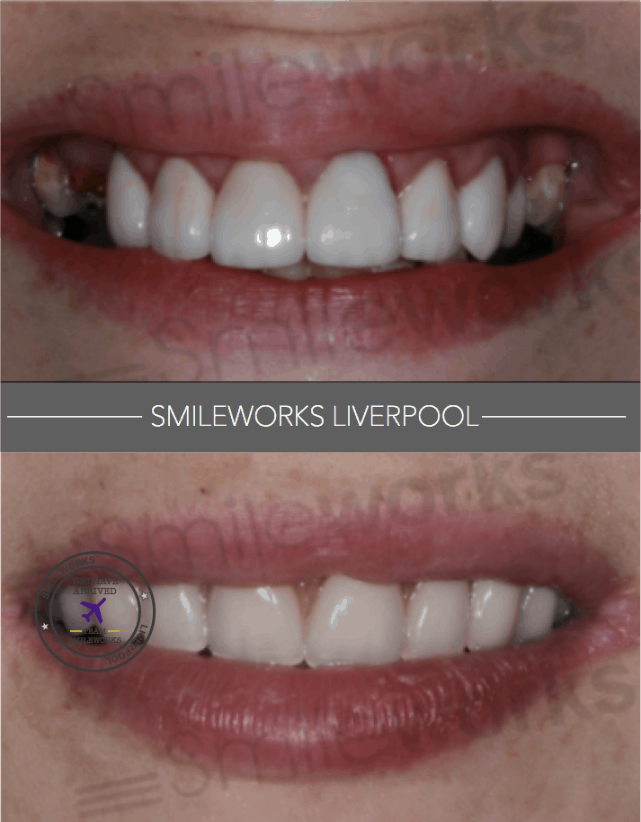 What is a reasonable price for dental implants?