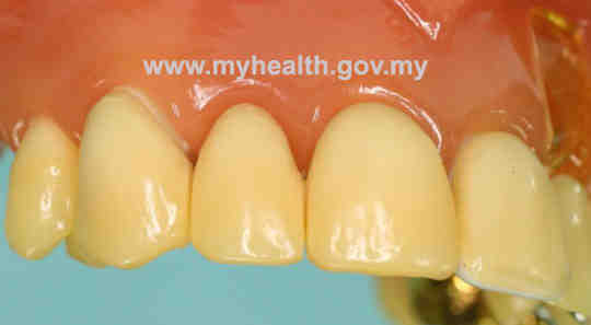 What is bad about dental implants?