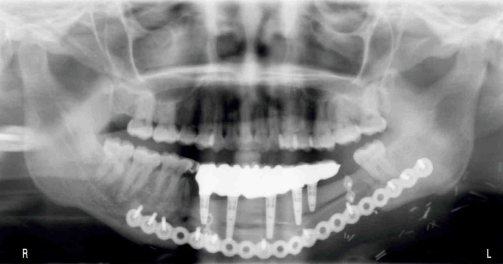 What is the flap for implant dental surgery? Dental News Network