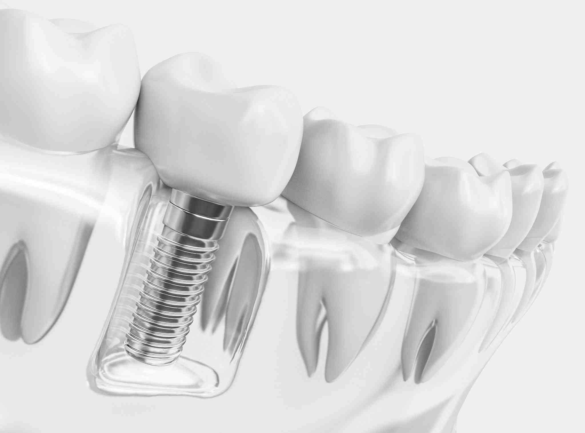 How painful is dental implants Dental News Network How painful is dental implants Dental News Network