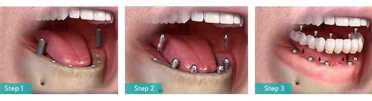 What is the average cost for a dental implant