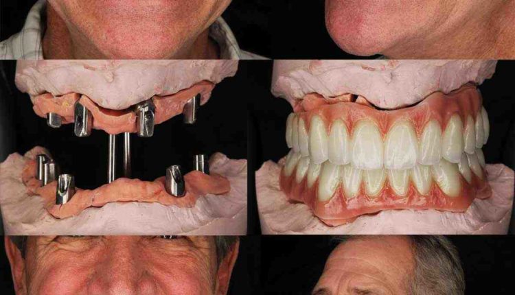 What is the average cost for full dental implants