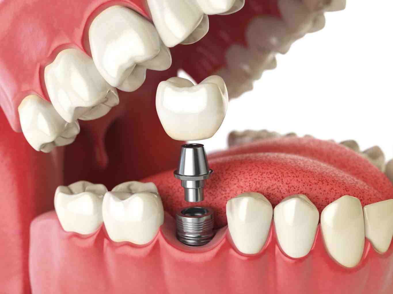 What is the average cost for full mouth implants?