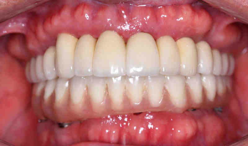 What is the average cost of 4 on 4 dental implants?