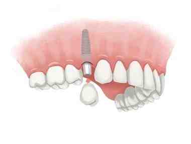 What is the average price for dental implants?