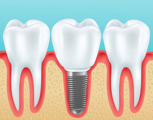 What is the cost of dental implants UK?