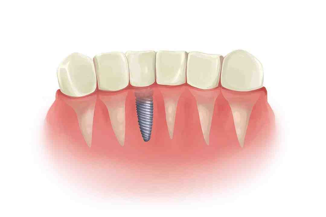 What is the failure rate of dental implants?