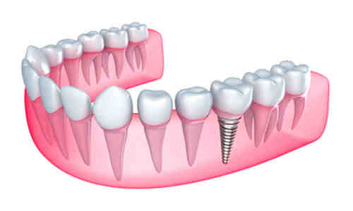 What is the main advantage of dental implants?