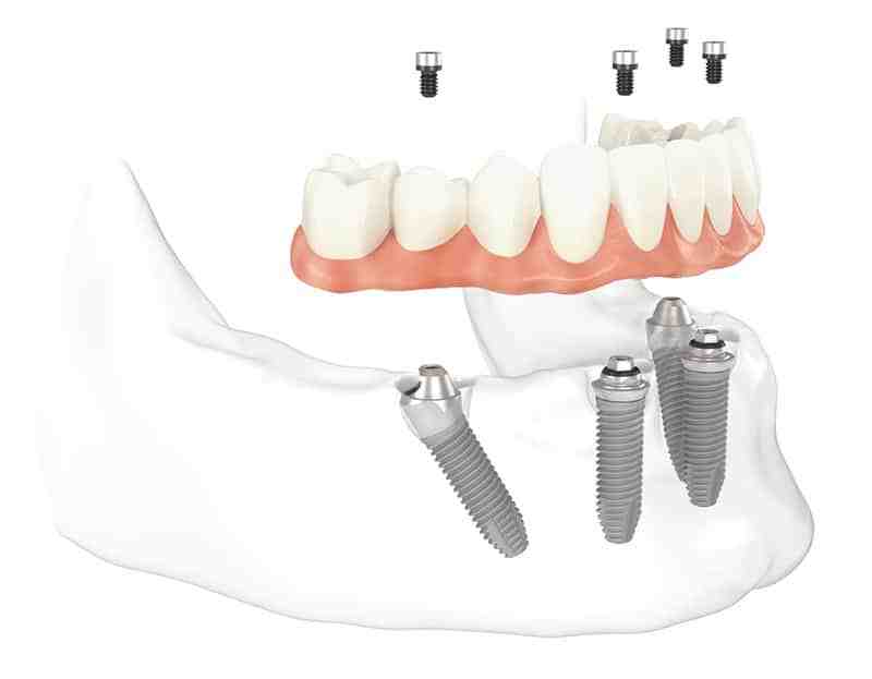 What is the meaning of All-on-4 dental implants?
