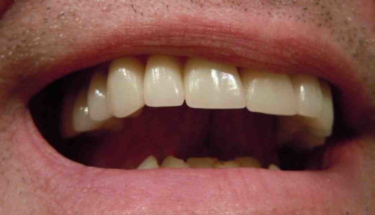 What is the procedure for dental implants