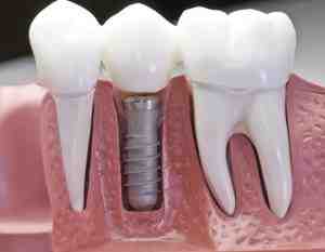 What kind of doctor puts in dental implants?