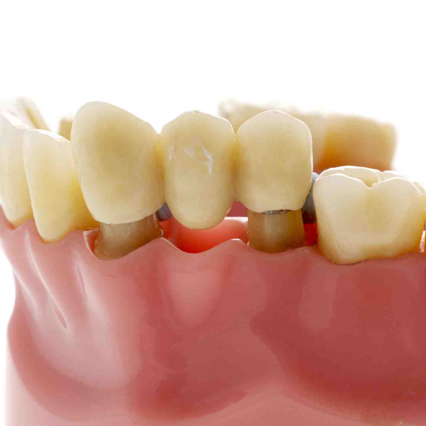 What last longer bridge or implant?