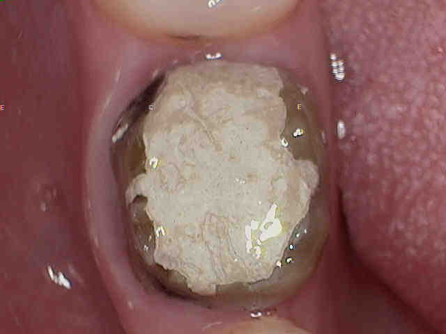 What medications are bad for dental implants?