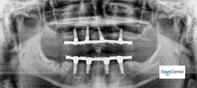 What rappers have dental implants?