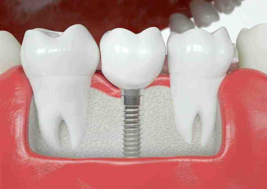 When is it too late to get dental implants?