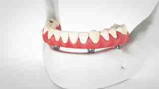 Where is the best place to get teeth implants?
