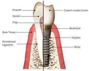 Which celebrities have implant teeth?