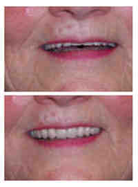 Which is better Aspen Dental or affordable dentures?