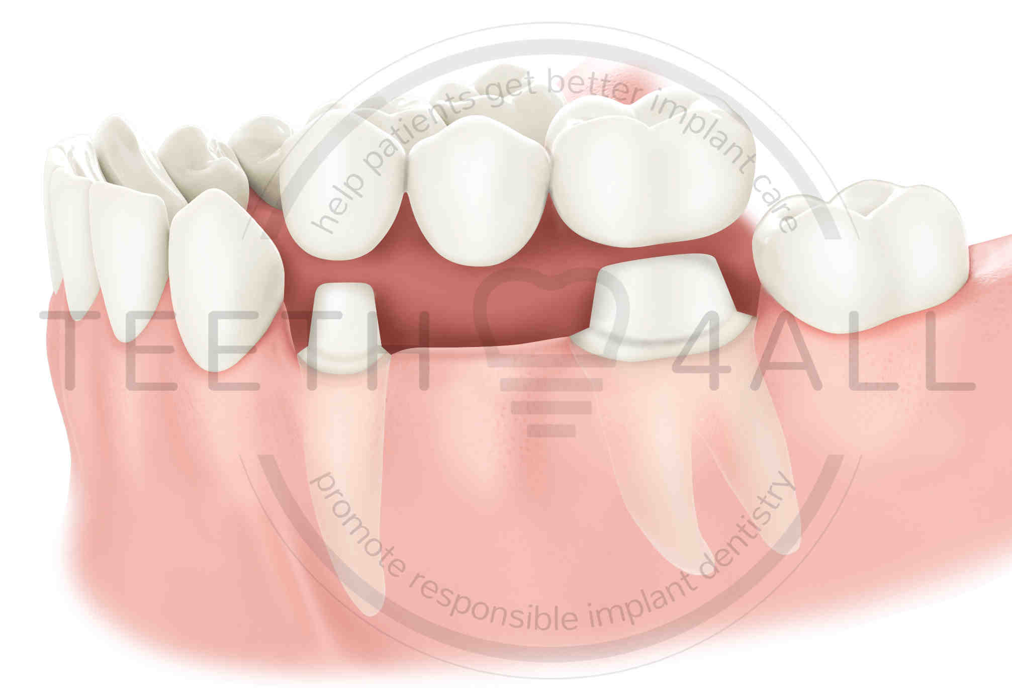 Which is better bridging or implant?
