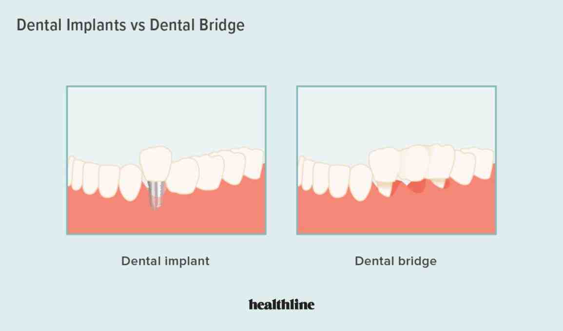 Who is not suitable for dental implants?