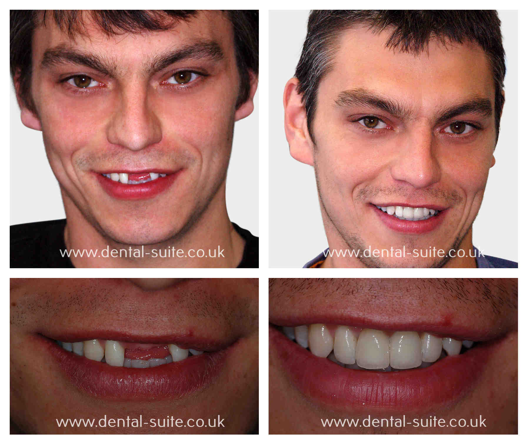 Бабочка на передний зуб. Люди с имплантами зубов. Имплантация зубов до и после.