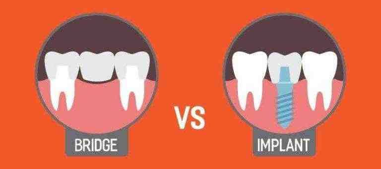 Why choose a dental implant over a bridge?
