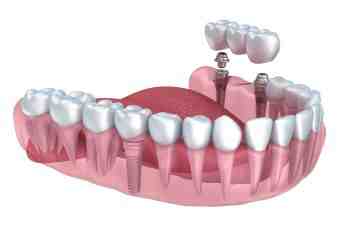 Why choose a dental implant over a bridge?