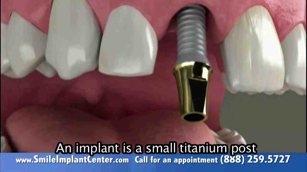 Will you lose facial features with dental implants?