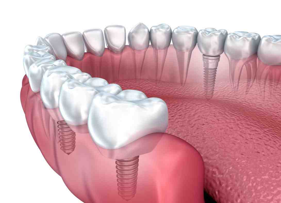 Are all on four dental implants comfortable?