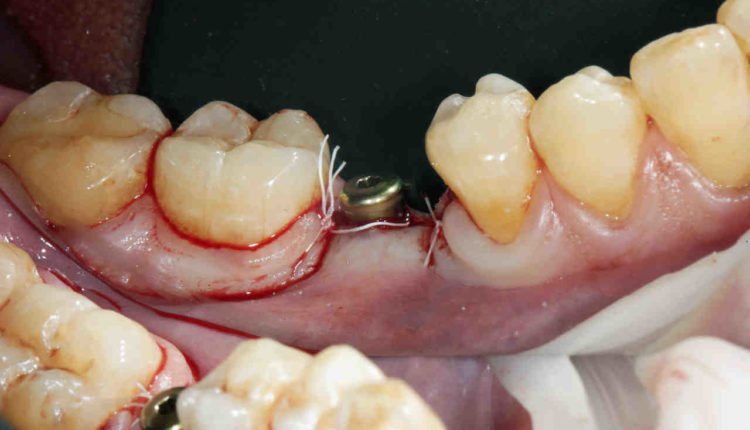 Are antibiotics necessary after dental implant surgery